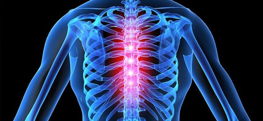 Scharfe Schmerzen sind charakteristisch für eine Verschlimmerung der Osteochondrose der Brustwirbelsäule
