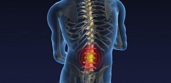 Rückenschmerzen mit Osteochondose der Lendenwirbelsäule