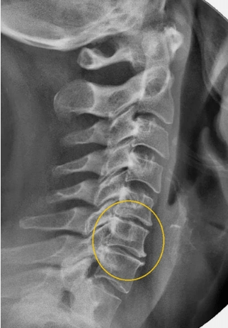 Osteochondrose der Halsspalte auf einem Radius X