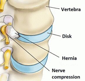 Osteochondrose der Gebärmutterhalsregion