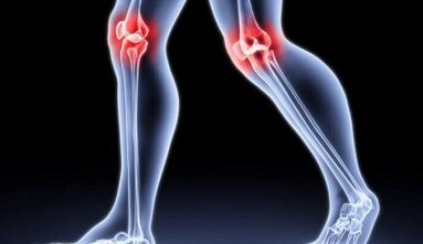 Vorbeugung der Entwicklung von Arthritis und Arthrose