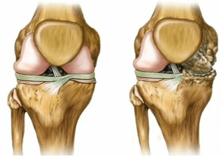 Osteoarthritis -Phase