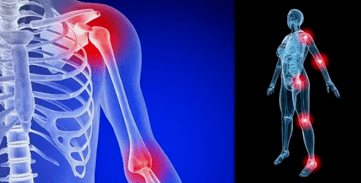 Verformung der Künste für Arthrose