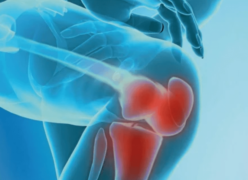 Was ist Arthrose
