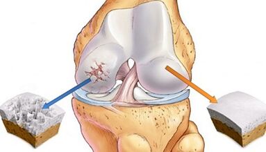 Ursachen der Arthrose der Gelenke