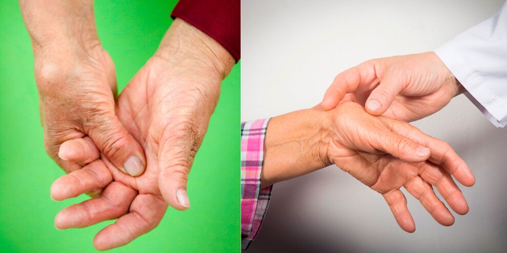 Schwellungen und schmerzende Schmerzen sind die ersten Anzeichen einer Arthritis der Hand