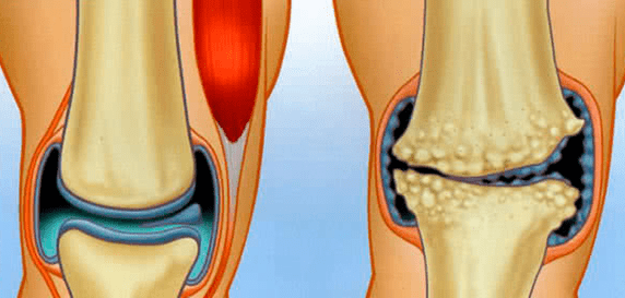 Normales Gelenk und Arthrose